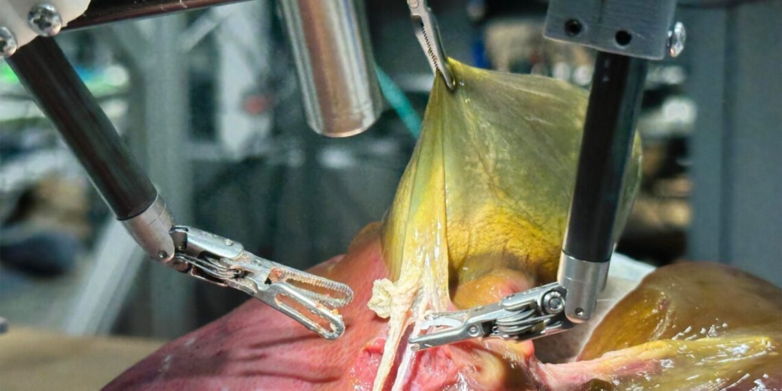 المسمار الإلكتروني | روبوت جراحي ينجز استئصال المرارة ذاتيًا للمرة الأولى بذكاء اصطناعي متقدم..