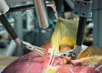 المسمار الإلكتروني | روبوت جراحي ينجز استئصال المرارة ذاتيًا للمرة الأولى بذكاء اصطناعي متقدم..