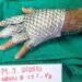 جلد سمك البلطي لعلاج الحروق.. ضماد بيولوجي واعد يخفف الألم ويسرّع التعافي