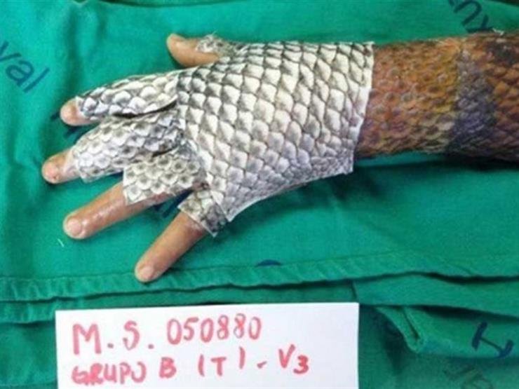 جلد سمك البلطي لعلاج الحروق.. ضماد بيولوجي واعد يخفف الألم ويسرّع التعافي 1 جلد سمك البلطي لعلاج الحروق.. ضماد بيولوجي واعد يخفف الألم ويسرّع التعافي